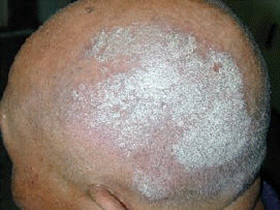 Exemple de psoriasis du cuir chevelu.